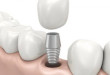 Trồng răng Implant có đau không? XEM NGAY TẠI ĐÂY