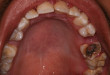 Bác sĩ nha khoa chia sẻ cách chữa sâu răng hiệu quả cho từng giai đoạn