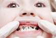 Báo động tình trạng viêm tủy răng ở trẻ em hiện nay