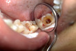 Nguyên nhân gây viêm tủy răng và cách phòng ngừa hiệu quả