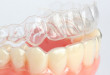 Niềng răng tháo lắp có hiệu quả không? Bs nha khoa giải đáp