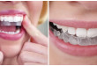 Tẩy trắng răng tại nhà- Nhanh nhất- Hiệu quả nhất