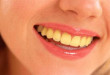 Giải đáp thắc mắc- Vì sao răng bị vàng?