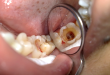 Viêm tủy răng có nguy hiểm không nếu không được chữa kịp thời?