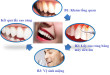 Quy trình lấy cao răng chuẩn xác và an toàn