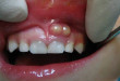 Viêm nướu răng ở trẻ em bệnh cần đề phòng