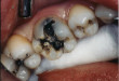 Chuyên gia tư vấn: Chữa răng sâu ở đâu tốt?
