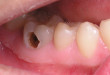 Hàn răng sâu có đau không? Cùng xem bác sĩ tư vấn bên dưới