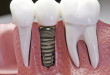 Tìm hiểu quy trình làm răng sứ chuẩn để có hàm răng hoàn mỹ nhất