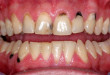 Trám răng và trường hợp nào nên trám răng bạn nên biết