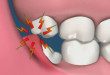 Mọc răng khôn có ý nghĩa gì không? Và có nên nhổ răng khôn?