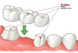 Cầu răng sứ là gì? ưu nhược điểm của cầu răng sứ