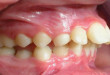 Răng hô là gì và cách nào trị răng hô hiệu quả