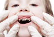 Trẻ em răng sữa bị sâu có nên hàn để giữ răng?