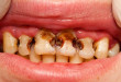 Sâu răng cửa – Giải pháp phù hợp cho từng mức độ răng sâu
