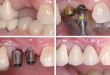 Cấy răng implant có đau không và ảnh hưởng đến xương hàm không?