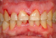 Viêm nướu và trị bệnh viêm nướu răng như thế nào?