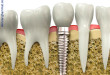 Có nên trồng răng implant khi bị mất răng hay không?