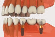 Cấy răng implant bao lâu thì ăn nhai bình thường?
