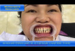 Đây là cách chỉnh hình răng thưa bằng cách an toàn và hiệu quả vĩnh viễn