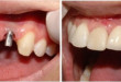 Cắm implant răng cửa nên hay không nên?