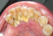 Cao răng là gì và được hình thành từ đâu?