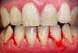Chảy máu nướu răng là bệnh gì? Cách điều trị như thế nào?