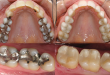 Hàn răng sâu có chấm dứt được sâu răng không?
