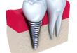 Làm răng implant có đau không? Có nguy hiểm gì không?