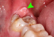Sâu răng khôn có nên nhổ bỏ hay trám răng?