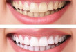 So sánh 2 phương pháp tẩy trắng răng và lấy cao răng