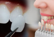 Dán sứ veneer  – Đỉnh cao công nghệ thẩm mỹ răng sứ 2020