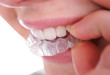 Quy trình niềng răng không mắc cài gồm những bước nào?