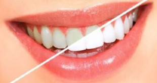 Bí mật cách tẩy trắng răng hiệu quả phương pháp làm đẹp an toàn 