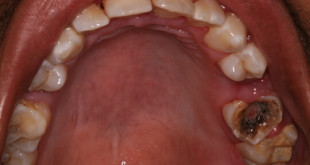 Bác sĩ nha khoa chia sẻ cách chữa sâu răng hiệu quả cho từng giai đoạn