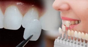 Dán sứ veneer  – Đỉnh cao công nghệ thẩm mỹ răng sứ 2020