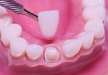 Làm mão răng sứ có đau không? Chuyên mục hỏi – đáp