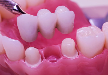Thông tin chọn lọc từ A – Z về cầu răng sứ cho người làm răng