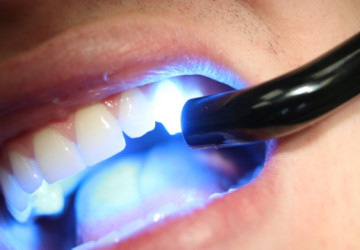Hàn răng sâu như thế nào để đạt độ bền chắc và hiệu quả cao nhất?