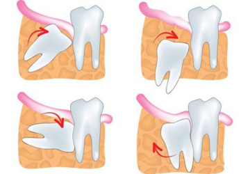 Bị mọc răng khôn phải làm sao để tránh những biến chứng có thể xảy ra