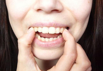 Làm thế nào để răng hết vẩu? Hãy lắng nghe chuyên gia trả lời
