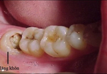Răng khôn là gì? Những nguyên nhân gây đau đớn khi mọc răng.