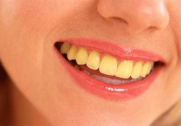 Giải đáp thắc mắc- Vì sao răng bị vàng?