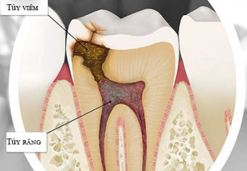 Viêm tủy răng là gì và những điều nhất định phải biết