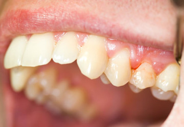 Cảnh báo bệnh nướu răng ai cũng dễ có thể gặp phải