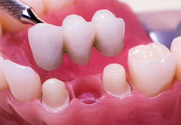 Làm cầu răng như thế nào? – Chi tiết kĩ thuật & các bước thực hiện