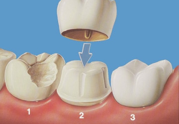 Bọc mão răng sứ là gì và quy trình bọc mão răng sứ như thế nào?