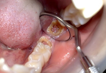 Bạn nên biết nhổ răng hàm có đau không trước khi quyết định nhổ răng