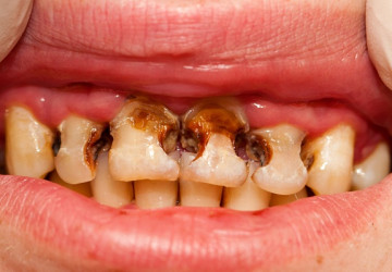 Sâu răng cửa – Giải pháp phù hợp cho từng mức độ răng sâu