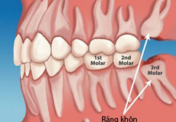 [Kiến thức nha khoa cơ bản] Răng khôn là răng số mấy?